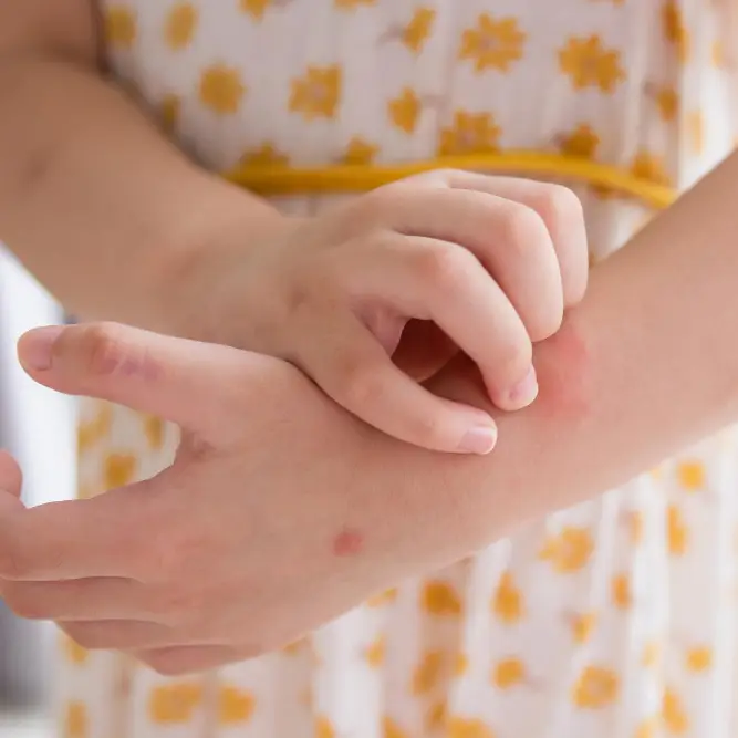 Pharmacy First Infected Insect Bite - Child itching bites